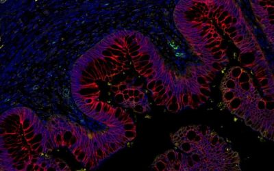 Étude de la récidive post-opératoire après chirurgie de la maladie de Crohn iléale : des interactions lymphoépithéliales aux facteurs de risques cliniques